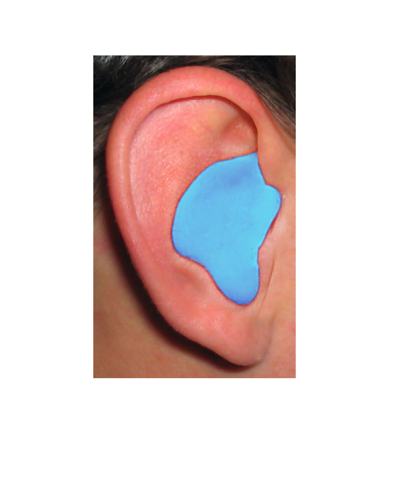 Radians Custom Molded Earplugs Blue